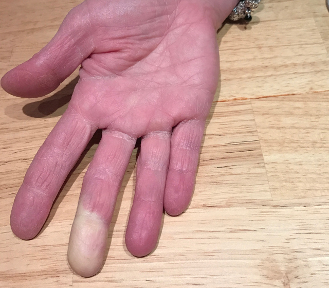ziekte van Raynaud
