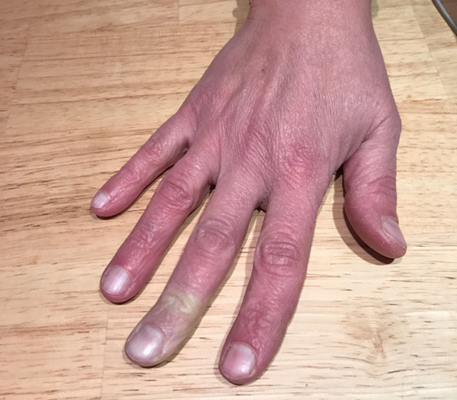 ziekte van Raynaud